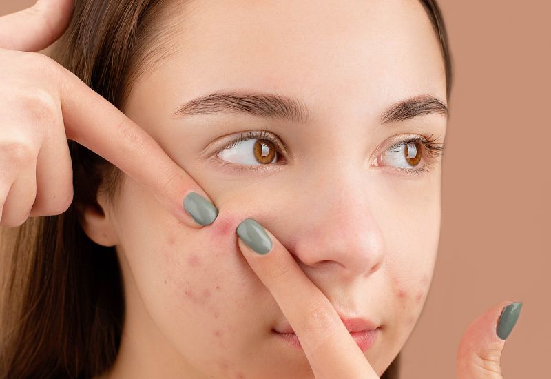 popping pimples - skincare mistakes to avoid