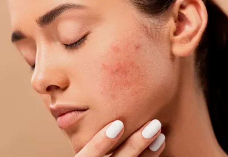acne fighting skincare routine