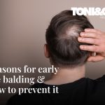 reasons-for-balding-at-a-young-age