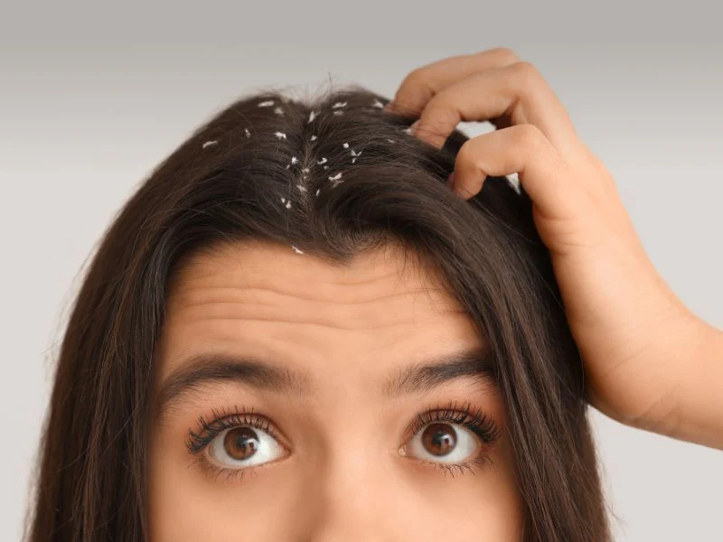 Dandruff 