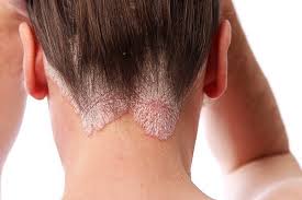 Scalp Psoriasis